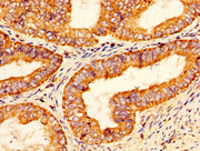 IHC image of CSB-PA018754LA01HU diluted at 1:200 and staining in paraffin-embedded human endometrial cancer performed on a Leica BondTM system. After dewaxing and hydration, antigen retrieval was mediated by high pressure in a citrate buffer (pH 6...