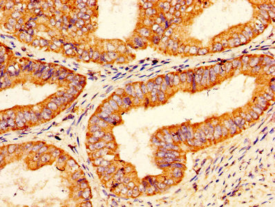IHC image of CSB-PA018754LA01HU diluted at 1:200 and staining in paraffin-embedded human endometrial cancer performed on a Leica BondTM system. After dewaxing and hydration, antigen retrieval was mediated by high pressure in a citrate buffer (pH 6...
