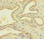 Immunohistochemistry of paraffin-embedded human prostate cancer using CSB-PA018834LA01HU at dilution of 1:100