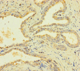 Immunohistochemistry of paraffin-embedded human prostate cancer using CSB-PA018834LA01HU at dilution of 1:100