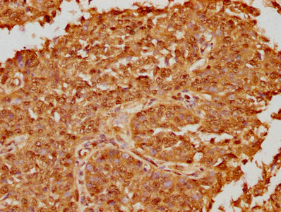 IHC image of CSB-PA018886LA01HU diluted at 1:100 and staining in paraffin-embedded human cervical cancer performed on a Leica BondTM system. After dewaxing and hydration, antigen retrieval was mediated by high pressure in a citrate buffer (pH 6.0)...