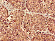 Immunohistochemistry of paraffin-embedded human ovarian cancer using CSB-PA018972LA01HU at dilution of 1:100