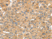 The image on the left is immunohistochemistry of paraffin-embedded Human liver cancer tissue using CSB-PA019029(NOX3 Antibody) at dilution 1/30, on the right is treated with synthetic peptide. (Original magnification: ×200)