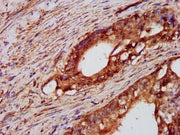 IHC image of CSB-PA019040LA01HU diluted at 1:600 and staining in paraffin-embedded human colon cancer performed on a Leica BondTM system. After dewaxing and hydration, antigen retrieval was mediated by high pressure in a citrate buffer (pH 6.0). S...