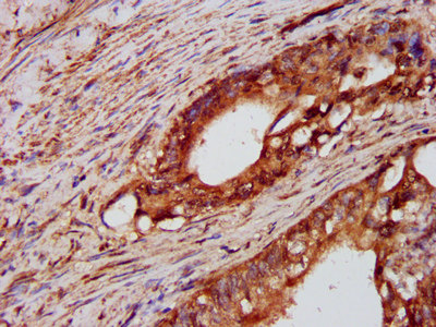 IHC image of CSB-PA019040LA01HU diluted at 1:600 and staining in paraffin-embedded human colon cancer performed on a Leica BondTM system. After dewaxing and hydration, antigen retrieval was mediated by high pressure in a citrate buffer (pH 6.0). S...