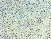 Immunohistochemistry of paraffin-embedded human breast cancer using CSB-PA019047DSR1HU at dilution of 1:100