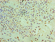 Immunohistochemistry of paraffin-embedded human breast cancer using CSB-PA019115HA01HU at dilution of 1:100