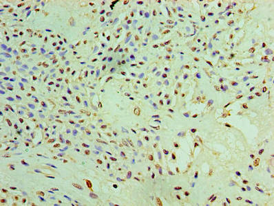 Immunohistochemistry of paraffin-embedded human breast cancer using CSB-PA019115HA01HU at dilution of 1:100