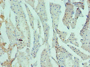 Immunohistochemistry of paraffin-embedded human prostate cancer using CSB-PA019268ESR2HU at dilution of 1:100