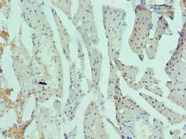 Immunohistochemistry of paraffin-embedded human prostate cancer using CSB-PA019268ESR2HU at dilution of 1:100