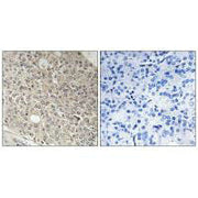 Immunohistochemistry analysis of paraffin-embedded human prostate carcinoma tissue using AMOTL1 antibody.