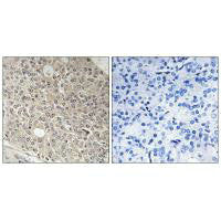Immunohistochemistry analysis of paraffin-embedded human prostate carcinoma tissue using AMOTL1 antibody.