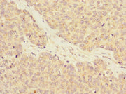 Immunohistochemistry of paraffin-embedded human ovarian cancer using CSB-PA019349ESR2HU at dilution of 1:100