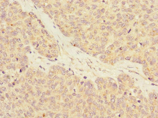Immunohistochemistry of paraffin-embedded human ovarian cancer using CSB-PA019349ESR2HU at dilution of 1:100