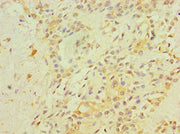 Immunohistochemistry of paraffin-embedded human breast cancer using CSB-PA019386ESR2HU at dilution of 1:100
