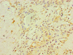 Immunohistochemistry of paraffin-embedded human breast cancer using CSB-PA019386ESR2HU at dilution of 1:100