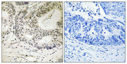 Immunohistochemistry analysis of paraffin-embedded human colon carcinoma tissue using 53BP1 (Phospho-Ser25) antibody. The picture on the right is treated with the synthesized peptide.