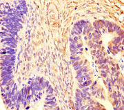 Immunohistochemistry of paraffin-embedded human ovarian cancer using CSB-PA019515HA01HU at dilution of 1:100