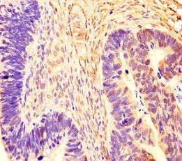 Immunohistochemistry of paraffin-embedded human ovarian cancer using CSB-PA019515HA01HU at dilution of 1:100