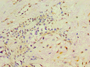 Immunohistochemistry of paraffin-embedded human breast cancer using CSB-PA019572DSR2HU at dilution of 1:100