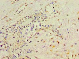 Immunohistochemistry of paraffin-embedded human breast cancer using CSB-PA019572DSR2HU at dilution of 1:100