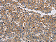 The image on the left is immunohistochemistry of paraffin-embedded Human liver cancer tissue using CSB-PA019605(KCNG1 Antibody) at dilution 1/40, on the right is treated with synthetic peptide. (Original magnification: ×200)