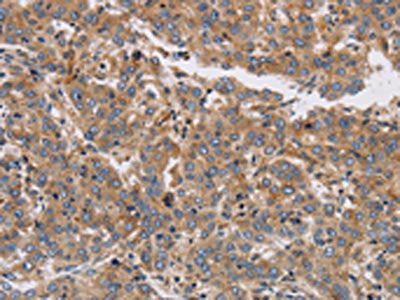 The image on the left is immunohistochemistry of paraffin-embedded Human liver cancer tissue using CSB-PA019605(KCNG1 Antibody) at dilution 1/40, on the right is treated with synthetic peptide. (Original magnification: ×200)