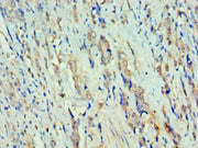 Immunohistochemistry of paraffin-embedded human colon cancer using CSB-PA019614ESR2HU at dilution of 1:100