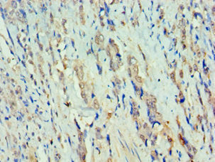 Immunohistochemistry of paraffin-embedded human colon cancer using CSB-PA019614ESR2HU at dilution of 1:100
