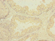 Immunohistochemistry of paraffin-embedded human prostate cancer using CSB-PA019640ESR2HU at dilution of 1:100