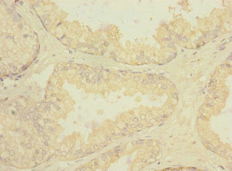 Immunohistochemistry of paraffin-embedded human prostate cancer using CSB-PA019640ESR2HU at dilution of 1:100