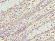 Immunohistochemistry of paraffin-embedded human colon cancer using CSB-PA019657ESR1HU at dilution of 1:100