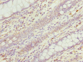 Immunohistochemistry of paraffin-embedded human colon cancer using CSB-PA019657ESR1HU at dilution of 1:100