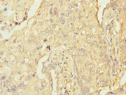 Immunohistochemistry of paraffin-embedded human lung cancer using CSB-PA019662ESR1HU at dilution of 1:100