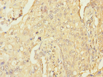 Immunohistochemistry of paraffin-embedded human lung cancer using CSB-PA019662ESR1HU at dilution of 1:100