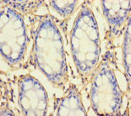 Immunohistochemistry of paraffin-embedded human colon cancer using CSB-PA019672LA01HU at dilution of 1:100