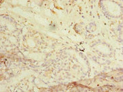 Immunohistochemistry of paraffin-embedded human breast cancer using CSB-PA019687LA01HU at dilution of 1:100