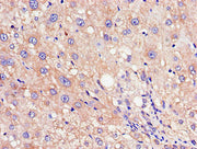 Immunohistochemistry of paraffin-embedded human liver cancer using CSB-PA019813LA01HU at dilution of 1:100