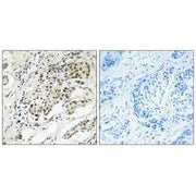 Immunohistochemistry analysis of paraffin-embedded human breast carcinoma tissue using CDYL2 antibody.