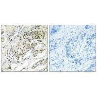 Immunohistochemistry analysis of paraffin-embedded human breast carcinoma tissue using CDYL2 antibody.