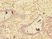 Immunohistochemistry of paraffin-embedded human colon cancer using CSB-PA019860LA01HU at dilution of 1:100