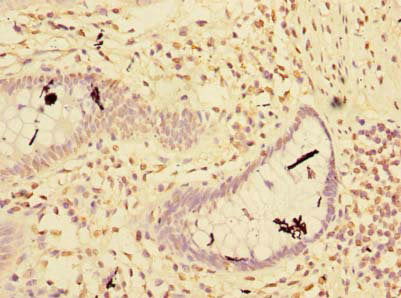 Immunohistochemistry of paraffin-embedded human colon cancer using CSB-PA019860LA01HU at dilution of 1:100