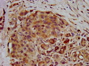 IHC image of CSB-PA019888LA01HU diluted at 1:400 and staining in paraffin-embedded human pancreatic cancer performed on a Leica BondTM system. After dewaxing and hydration, antigen retrieval was mediated by high pressure in a citrate buffer (pH 6....