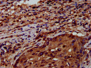 IHC image of CSB-PA019892LA01HU diluted at 1:600 and staining in paraffin-embedded human lung cancer performed on a Leica BondTM system. After dewaxing and hydration, antigen retrieval was mediated by high pressure in a citrate buffer (pH 6.0). Se...
