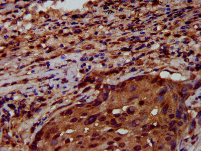 IHC image of CSB-PA019892LA01HU diluted at 1:600 and staining in paraffin-embedded human lung cancer performed on a Leica BondTM system. After dewaxing and hydration, antigen retrieval was mediated by high pressure in a citrate buffer (pH 6.0). Se...