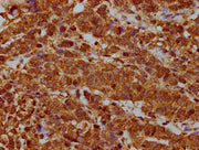 IHC image of CSB-PA020350LA01HU diluted at 1:400 and staining in paraffin-embedded human ovarian cancer performed on a Leica BondTM system. After dewaxing and hydration, antigen retrieval was mediated by high pressure in a citrate buffer (pH 6.0)....