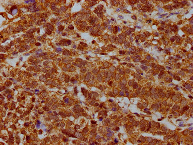 IHC image of CSB-PA020350LA01HU diluted at 1:400 and staining in paraffin-embedded human ovarian cancer performed on a Leica BondTM system. After dewaxing and hydration, antigen retrieval was mediated by high pressure in a citrate buffer (pH 6.0)....