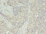 Immunohistochemistry of paraffin-embedded human gastric cancer using CSB-PA020430LA01HU at dilution of 1:100