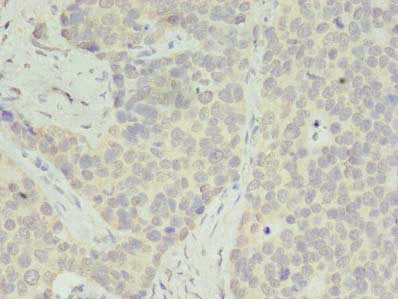 Immunohistochemistry of paraffin-embedded human gastric cancer using CSB-PA020430LA01HU at dilution of 1:100