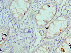 Immunohistochemistry of paraffin-embedded human colon cancer using CSB-PA020456ESR2HU at dilution of 1:100
